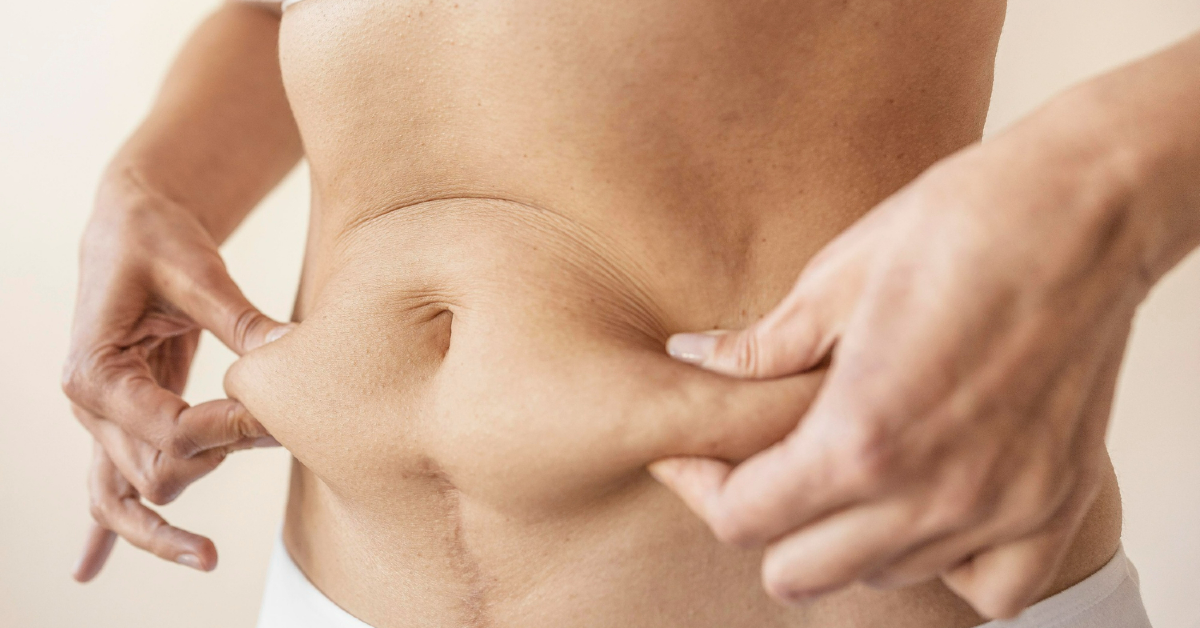 Addominoplastica e liposuzione