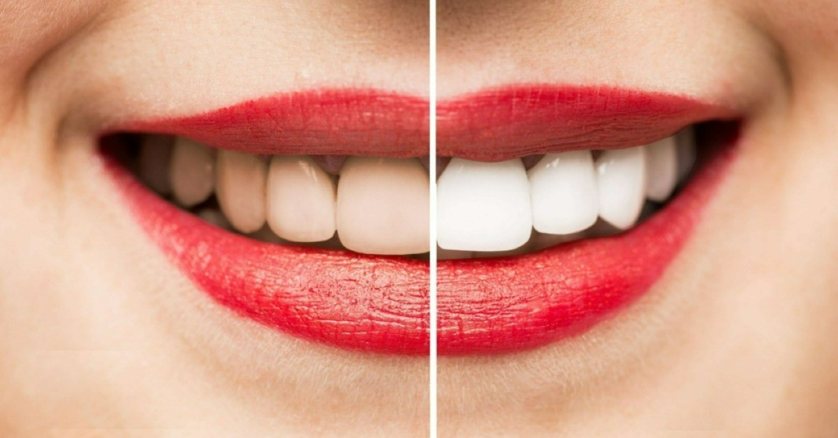 Teeth Whitening