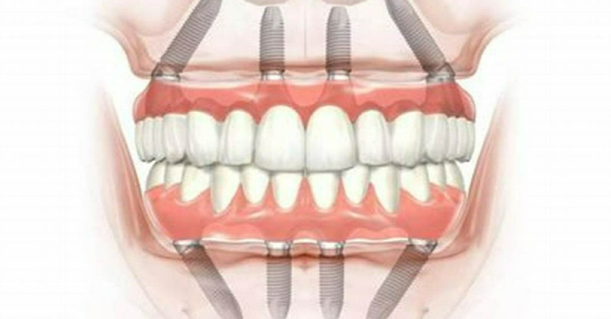 Zygoma implants