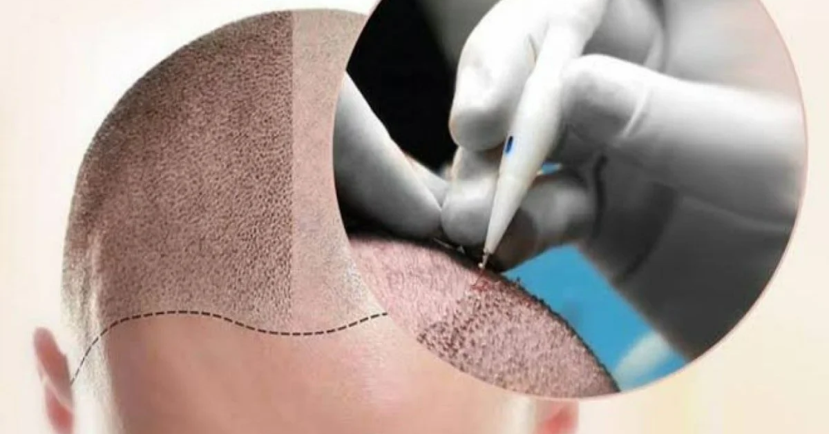 DHI (Direct Hair Implantation)