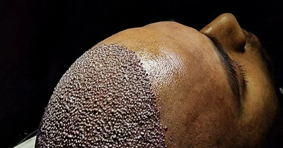 FUE (Follicular Unit Extraction)