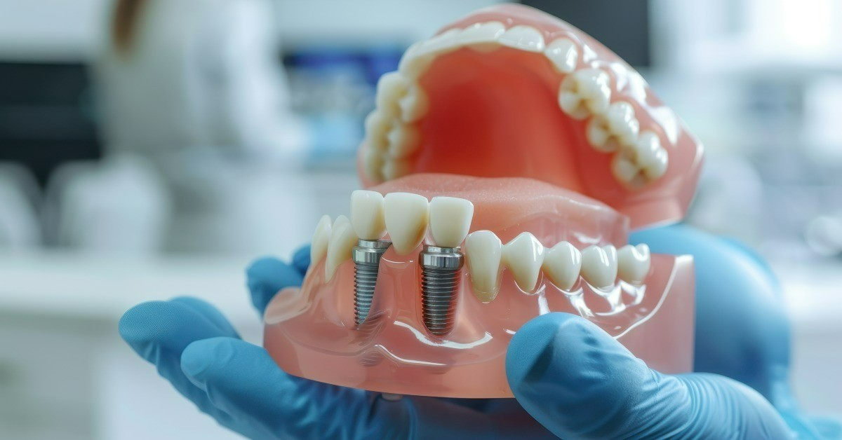 Dental Implants