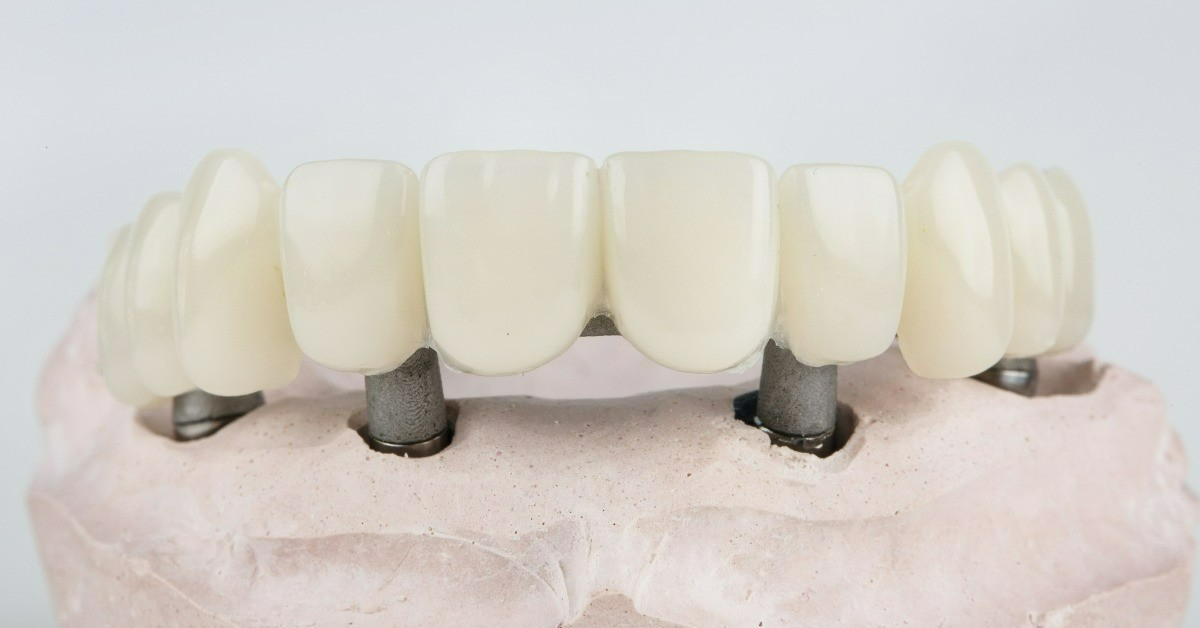 All-on-4/6 implants
