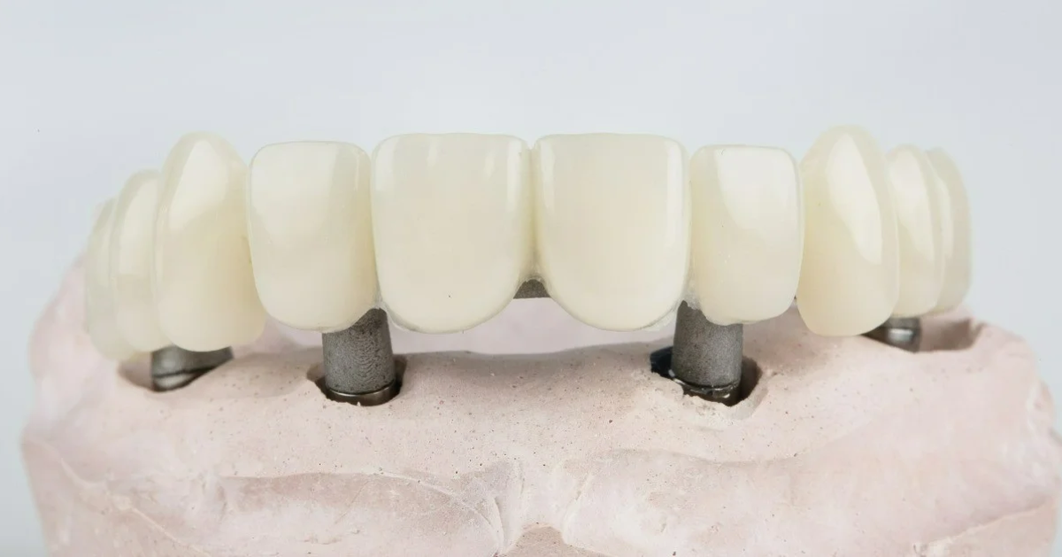 All-on-4/6 Implants