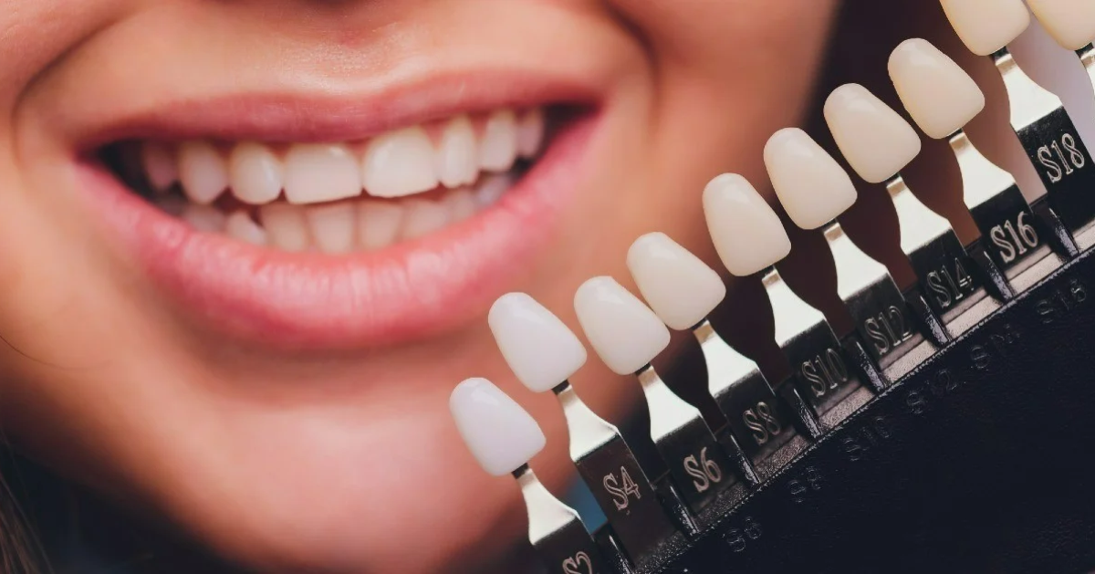Emax Veneers