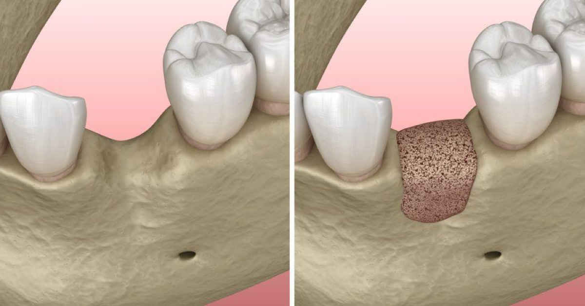 Bone Grafting